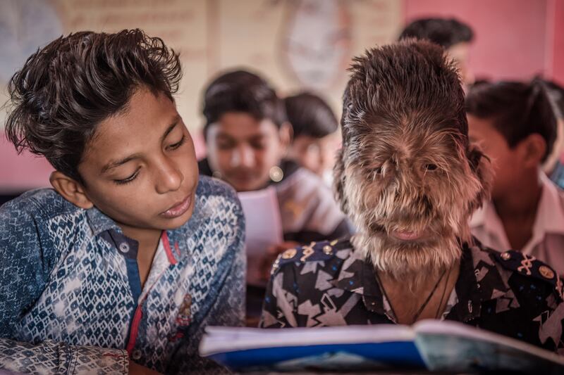 ‘Werewolf syndrome’: hypertrichosis is a rare condition that causes thick hair to grow over the body, often on the face, as in the case of this 13-year-old Indian schoolboy, Lalit Patidar. Photograph: Shams Qari/Barcroft via Getty