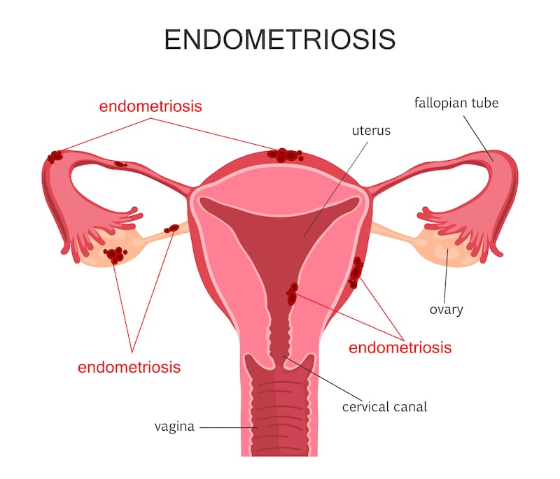 Enometriosis can have a big impact on lives, but there are treatments that can help. Illustration: Getty Images