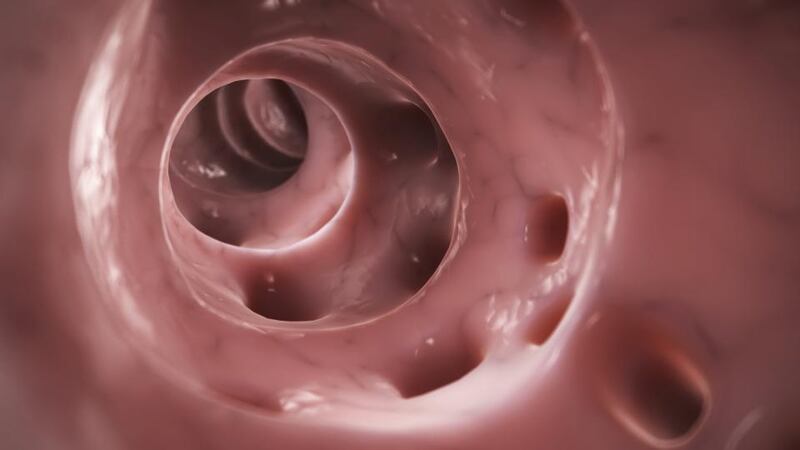 Diverticulosis is characterised by small pouches that occur in the wall of the colon. These marble-sized pouches bulge outwards through weak areas of the wall. Photograph: Getty Images