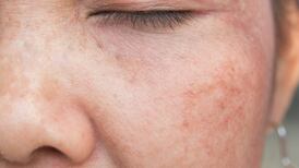 Skincare in the sun: How to tackle post-sun pigmentation