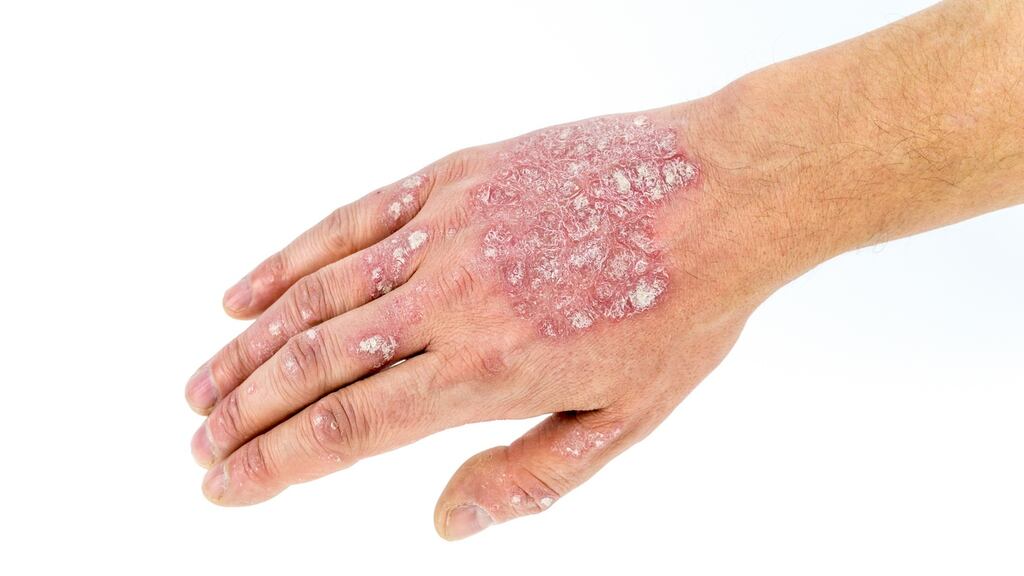 Psoriasis: affects all aspects of patients’ lives when severe