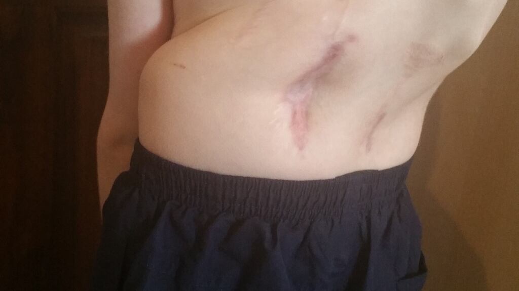 Before: Tommy Long, whose congenital scoliosis meant he was unable to play like other children