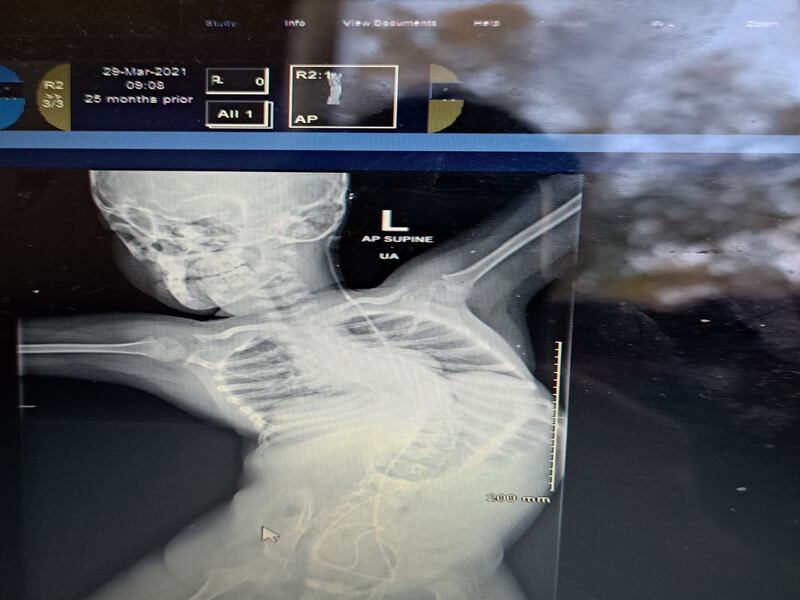 X-ray of Harvey Sherratt (8), from Clondalkin, Dublin, who has been on a waiting list for surgery for seven years