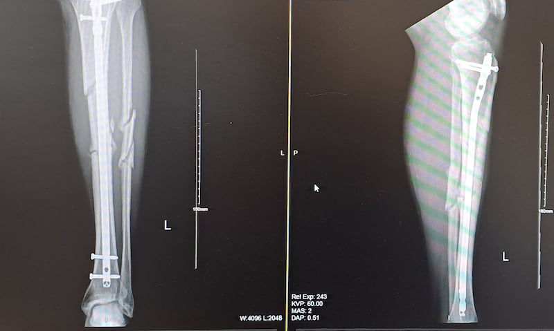 An X-ray image showing Karl Leonard's legl after he was struck by an e-bike in Swords, Dublin
