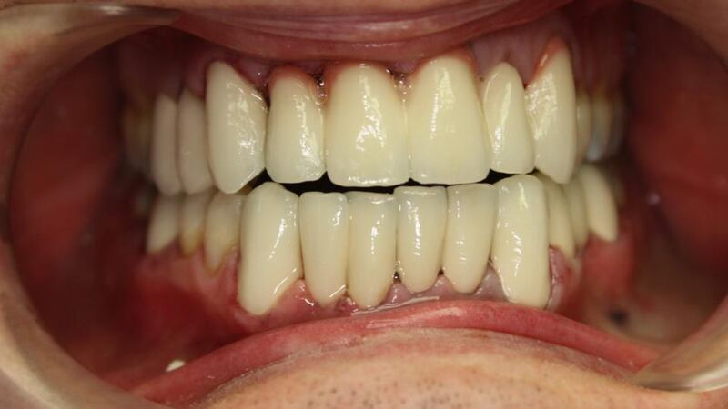 After: William Murphy had 18 teeth worked on in Budapest.