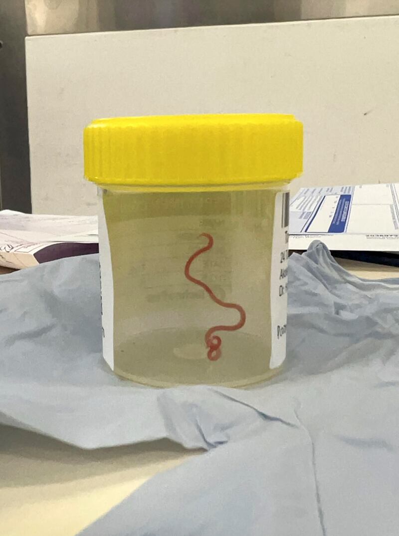The 3in parasitic worm was found in a woman’s brain during a biopsy at Canberra Hospital. Photograph: Canberra Health Services/AP