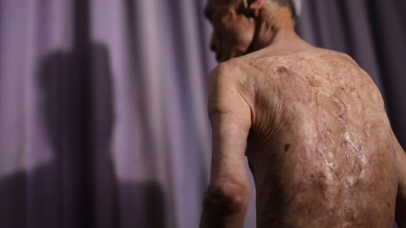 Sumiteru Taniguchi shows his back with scars of burns from the atomic bomb explosion, during an interview at his office in Nagasaki, southern Japan in 2015. File photograph: Eugene Hoshiko/AP
