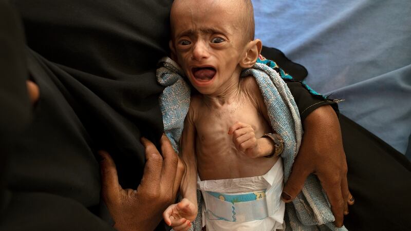 Five-month-old Ahmed Ibrahim al-Junid, who suffers from malnutrition and dehydration, at a clinic in Aslam, Yemen. Photograph: Tyler Hicks/The New York Times