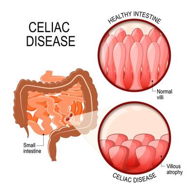 Diagram shows changes in the intestine caused by coeliac disease, which is manifested by the blunting of villi.