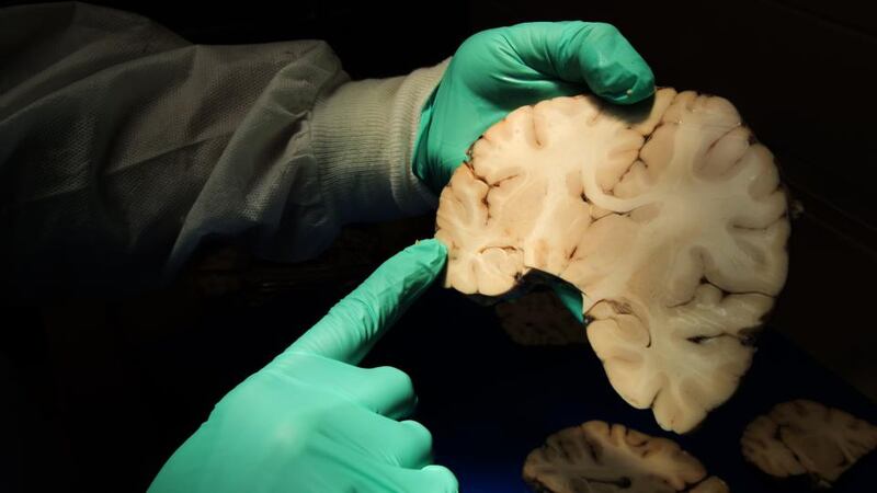 Dr Ann McKee, Director of Boston Universitys CTE Center and Chief of Neuropathology at the VA Boston Healthcare System, analyses brain tissue in her study of former American footballers. Photo: Boston Globe/Getty Images