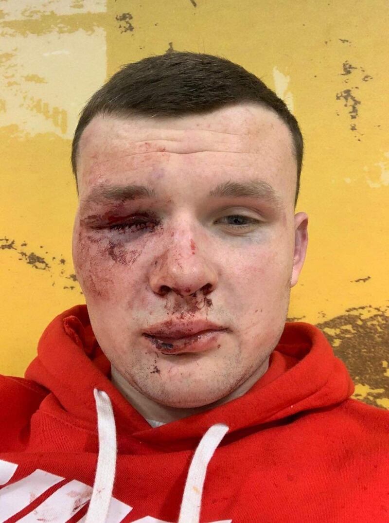 A photograph of Cillian McCarthy taken a short time after he was attacked inside and outside the Icon nightclub in 2019. Photograph: Brendan Gleeson