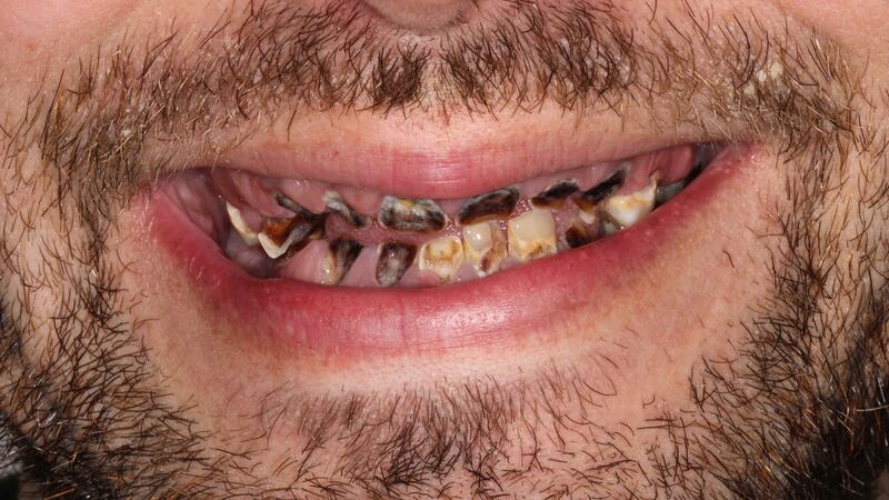 Michael Sheridan’s teeth before operation.