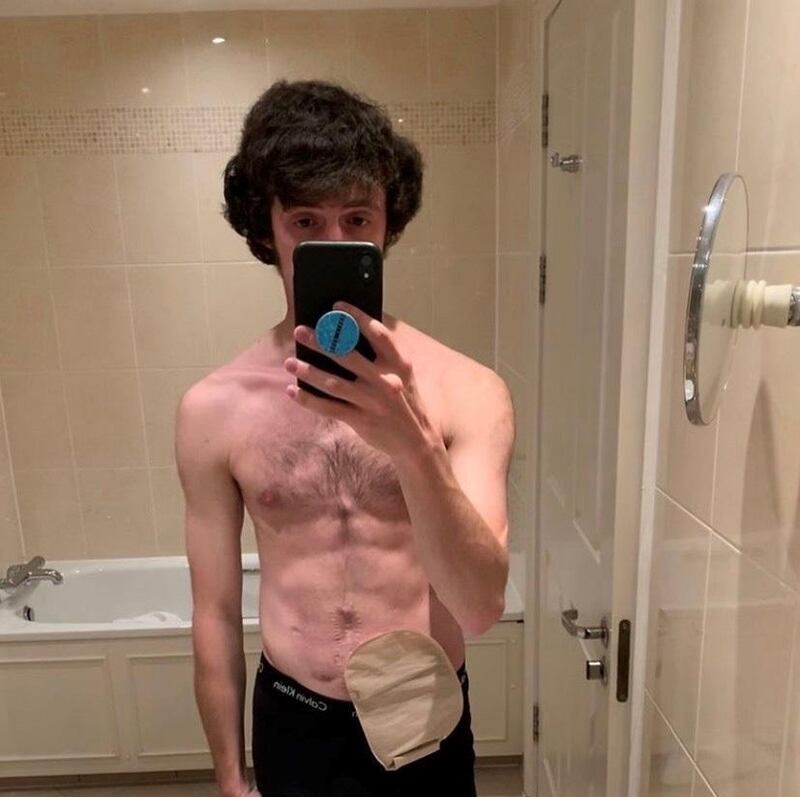 Andrew Browne: I also had to learn how to manage, change and take care of my ileostomy bag (which would be a permanent fixture).