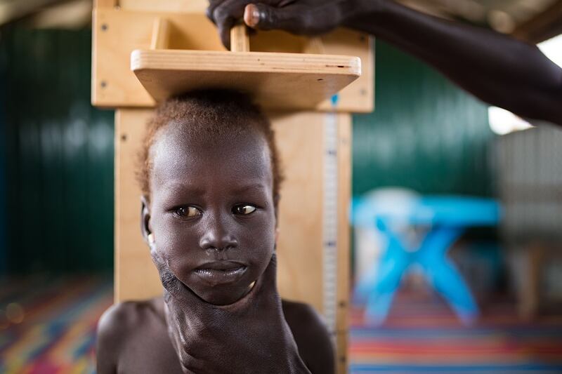 Hon Meat Zoal (3) having his height measured as part of the screening for Severe Acute Malnutrition at  one of Concern's nutrition centres in Bentiu PoC., South Sudan. Photo: Steve De Neef / Concern Worldwide.
