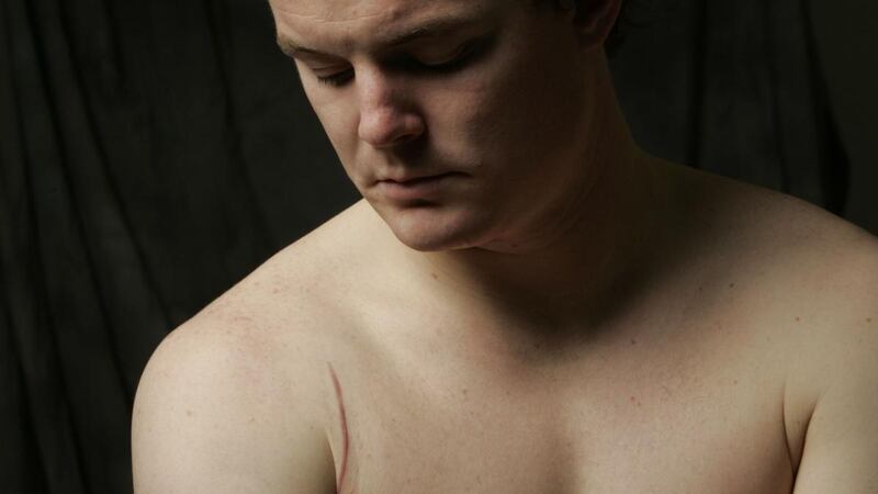 Brian O’Driscoll shows the scar from his shoulder operation following the spear tackle. Photograph: Billy Stickland/Inpho