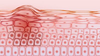As a result of people not seeking help for skin changes or being reluctant to contact their GP during the pandemic, they may be presenting with later more advanced disease. Photograph: iStock