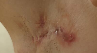 The armpit is one of the areas most commonly affected by HS and one of the most challenging places to dress and retain a dressing