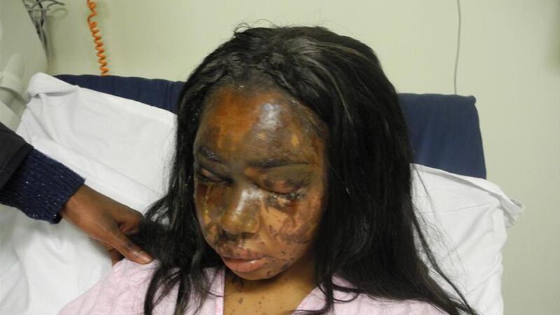 An undated handout photo issued by the Metropolitan Police of the injuries sustained by Naomi Oni after she had acid thrown in her face by Mary Konye. Photograph:  Metropolitan Police/PA Wire.