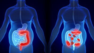 Inflammatory bowel diseases, including Crohn’s disease and ulcerative colitis, often occur early in life.