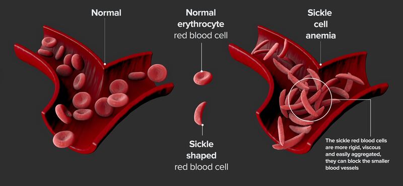 Sickle cell disease derives its name from the abnormal shape of the red blood cells that contain the haemoglobin affected by a gene mutation. Illustration: iStock