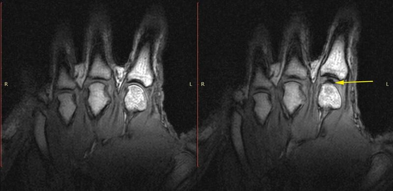Scans from a MRI machine that looked at what happened inside a knuckle when it cracked.