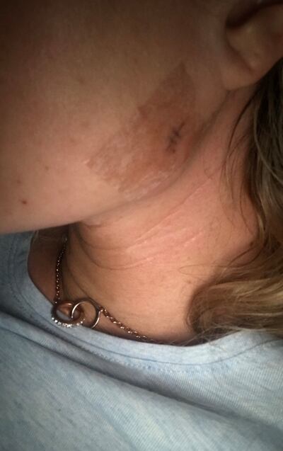 Some of the wounds Elaine was left with as a result of a botched dermal fillers procedure.