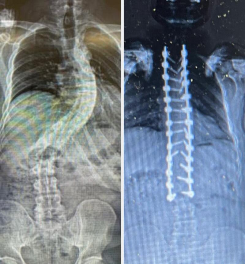 Kevin McIvor's spine before and after surgery in Turkey