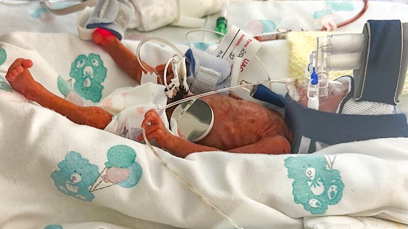 Raina Gilmore in Belfast's Royal Victoria Hospital. Raina is believed to be the smallest surviving premature baby ever born on the island of Ireland. Photograph: PA