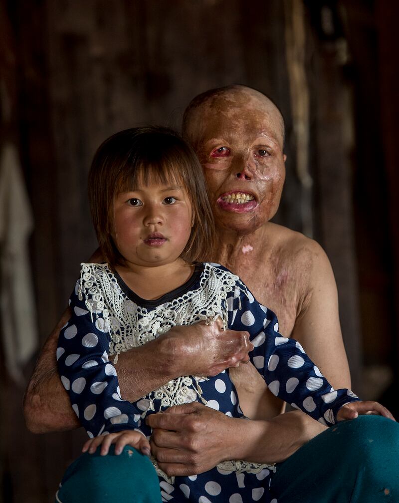 Yeyang Yang aged 31 with his daughter Syya aged 6 photographed at their home in Banxang village, Phonsavan, Laos. He was buring rubbish when the heat of the fire ignited a UXO in the ground and exploded. Yeyang spent 8 months in hospital and still has to undergo further surgery. Photograph: Brenda Fitzsimons / The Irish Times