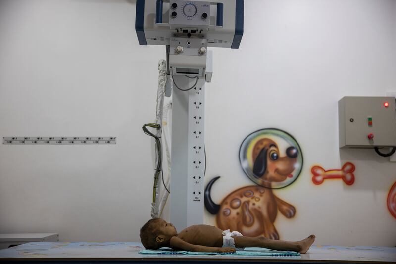 A Yanomami baby being treated at the hospital at a children’s hospital in Boa Vista, Brazil last month. Photograph: Victor Moriyama/The New York Times
             