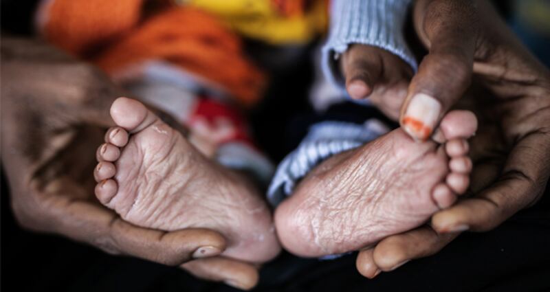 All eighteen months of Mazen’s life has been a struggle. He is suffering from acute malnutrition, skin diseases and another disease that resulted in losing one of his eyes. He’s been treated at Unicef supported hospital in Sana’a, Yemen. Photograph: Unicef/Yemen/2020/Alghabri