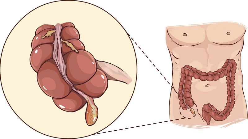 Vector illustration with detail of an appendicitis