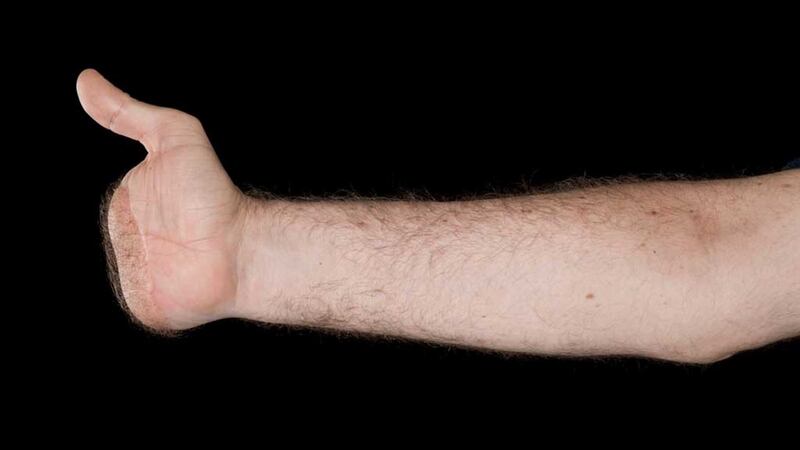 A before picture of the right hand of the UK’s first double hand transplant patient Chris King. Photograph: PA