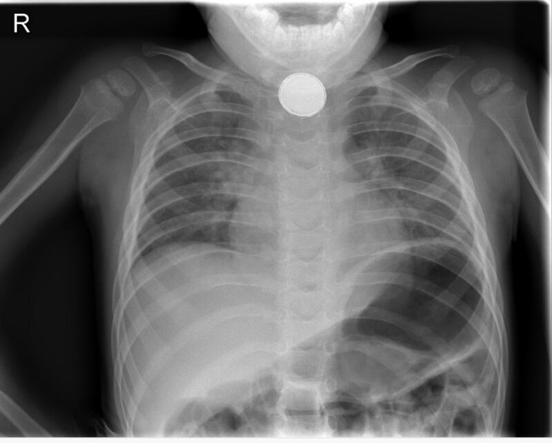 X-ray of Aaron Sikorski (6) from Tuam Co Galway, who settled a High Court action over care he received after he swallowed a button battery