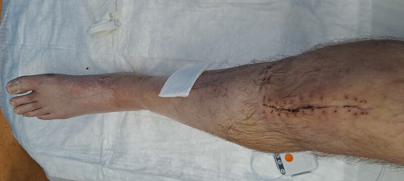 Karl Leonard's leg after he underwent surgery following the collision involving an e-bike