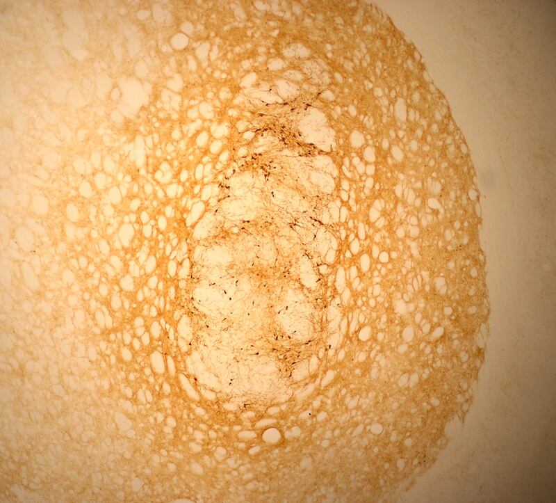 Picture depicts brain repair in Parkinson’s: transplanted brain cells survive better when implanted in collagen. Photo: NUI Galway