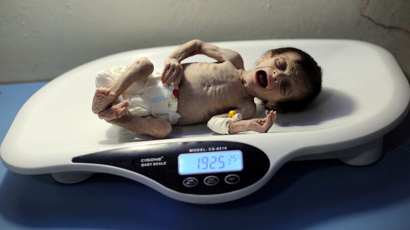 A Syrian infant suffering  severe malnutrition is  weighed at a clinic in the rebel-controlled town of Hamouria, eastern Ghouta,  Damascus,  October 21st, 2017. Photograph: Amer Almohibany/AFP/Getty Images