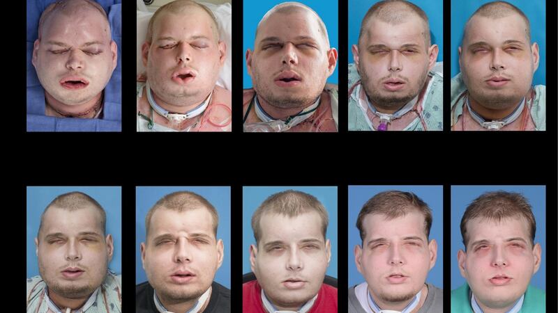 The progression of face transplant patient Patrick Hardison during his recovery at the NYU Langone Medical Center in New York. Photograph: AFP/Getty Images