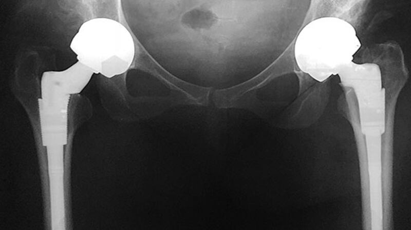 DePuy all-metal hips.