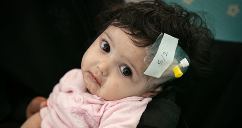 In Yemen Covid-19 threatens the lives of malnourished children like Diala’a. She is six-month-old girl and she is suffering from malnutrition and skin diseases. Photograph: Unicef/Yemen/2020/Alghabri