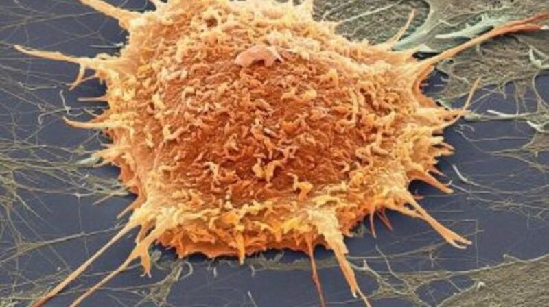 Magnified image of a cervical cancer cell. More than 1,500 women who developed cervical cancer did not have their cases reviewed by CervicalCheck. File photograph: Getty Images