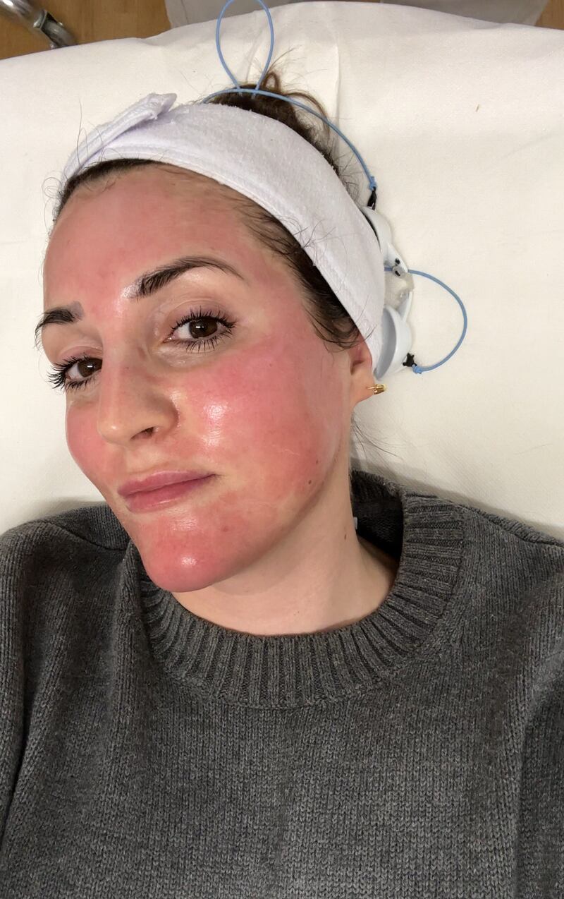 Simone Gannon immediately after PRP microneedling at Le Formulaire Clinic. Photograph: Simone Gannon