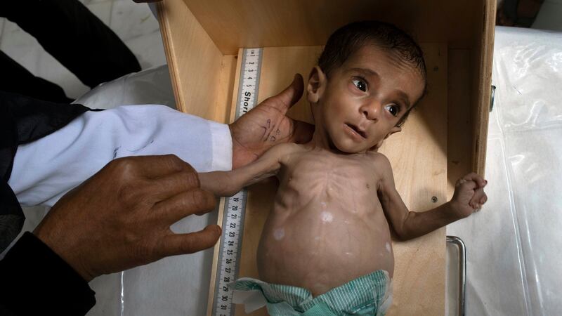 Wadah Askri Mesheel, 11 months old, is examined upon his arrival at a clinic in Aslam, Yemen. Photograph: Tyler Hicks/The New York Times