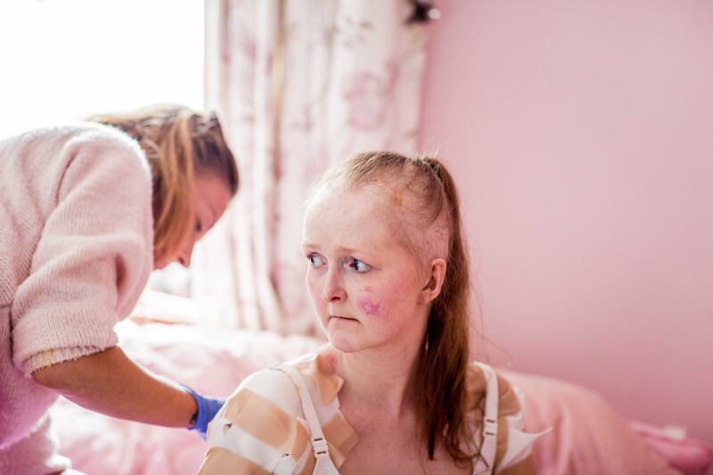 Emma Fogarty, pictured during extremely painful bandage changes, says no-one expected her to survive for this long because people with her type of EB rarely do. Photograph: Richard Sheehy.