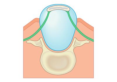 Illustration showing Spina Bifida Myelomeningocele, where part of spinal cord contained within the sac of cerebrospinal fluid protrudes through skin forming a large bulge.