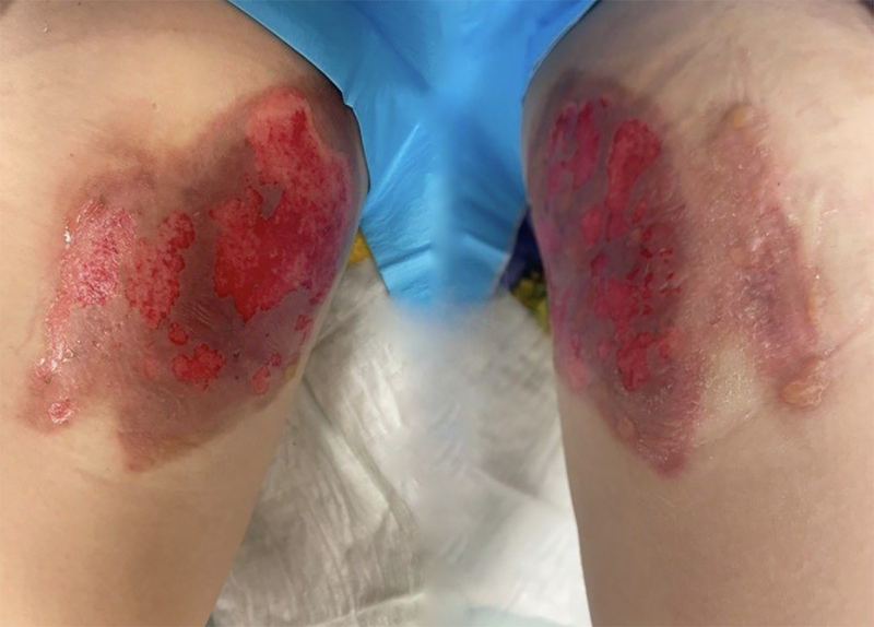 Burns to the inner thighs as a result of frostbite injury from contact with nitrous oxide canister. Photograph: Irish Medical Journal