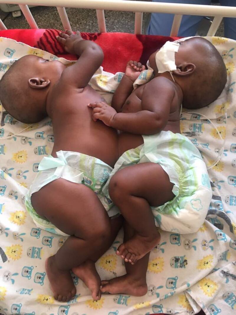 The conjoined twins - Bupe and Mapalo.