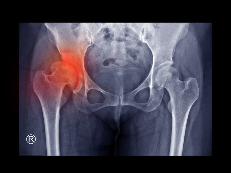 An X-ray shows developmental dysplasia of the hip (DDH). Photograph: iStock